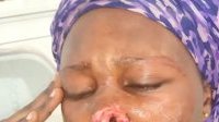 Lastourville : Une gabonaise perd une grosse partie de son nez lors d’une bagarre avec son copain
