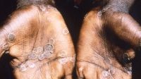 Variole du singe : l’OMS décidera la semaine prochaine si le virus représente une urgence sanitaire internationale
