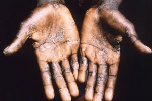 Variole du singe&nbsp;: l’OMS décidera la semaine prochaine si le virus représente une urgence sanitaire internationale